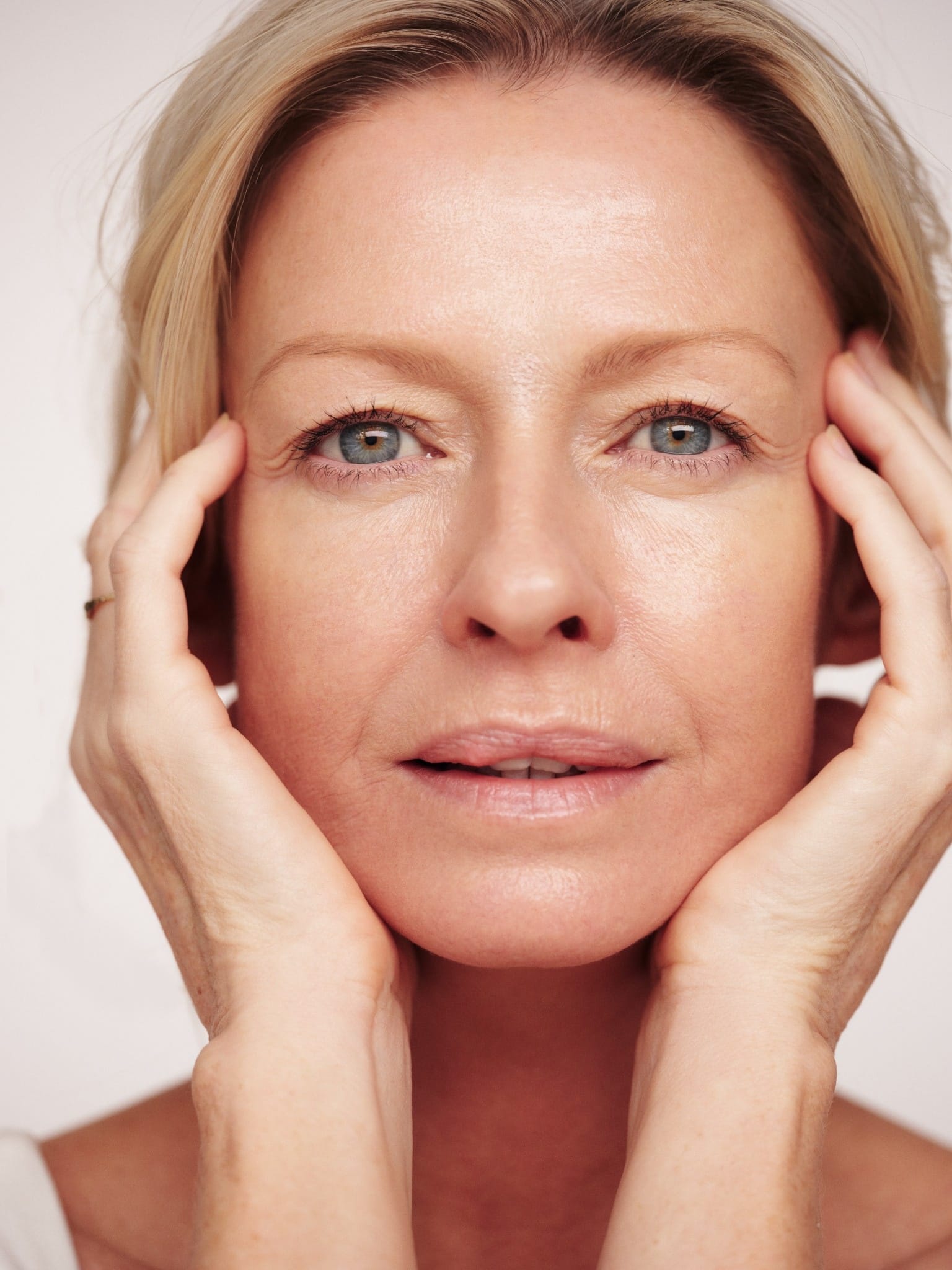 Marionette lines dermal volumisation