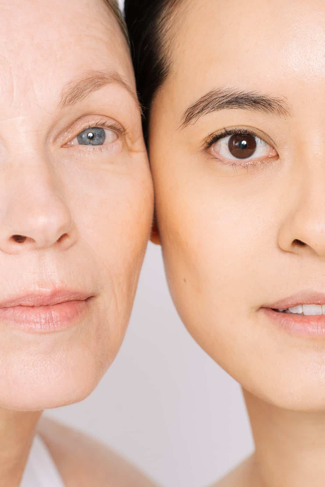 Nasolabial fold volumsation sydney