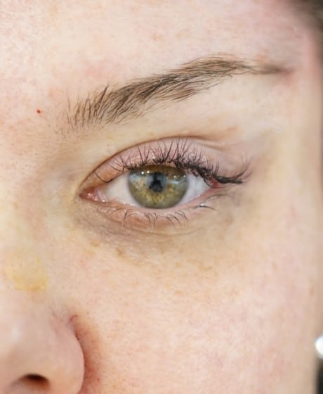 Female Fox Eye Thread after treatment at Contour Clinics