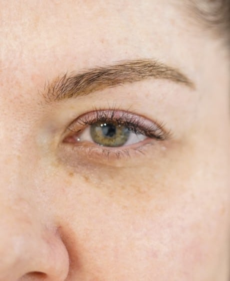 Female Fox Eye Thread after treatment at Contour Clinics