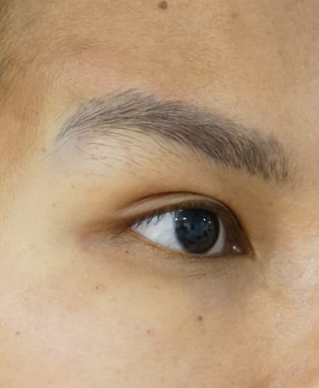 Female Fox Eye Thread after treatment at Contour Clinics