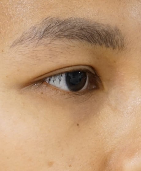 Female Fox Eye Thread before treatment at Contour Clinics