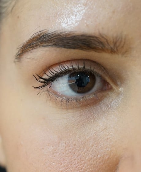 Female Fox Eye Thread before treatment at Contour Clinics