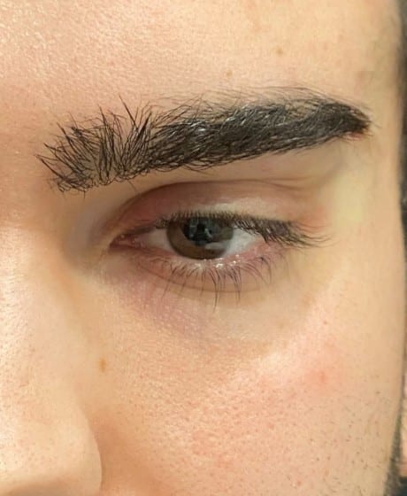 Male Fox Eye Thread after treatment at Contour Clinics