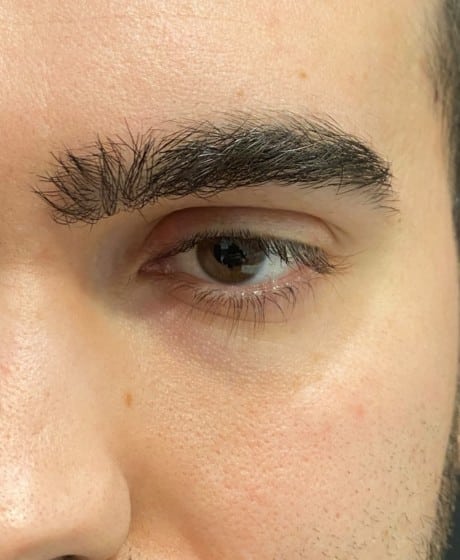 Male Fox Eye Thread before treatment at Contour Clinics