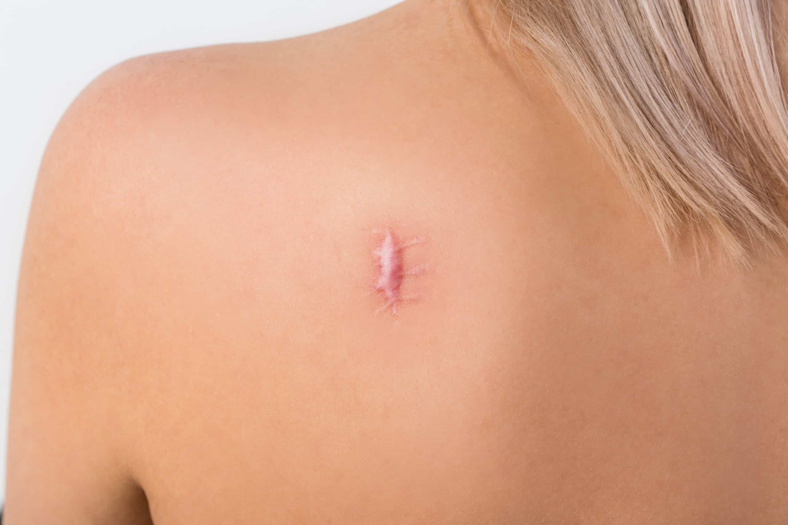 Laser scar treatment