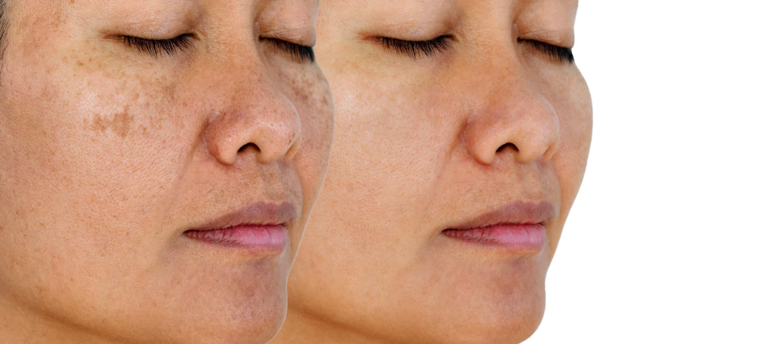 Pigmentation removal sydney
