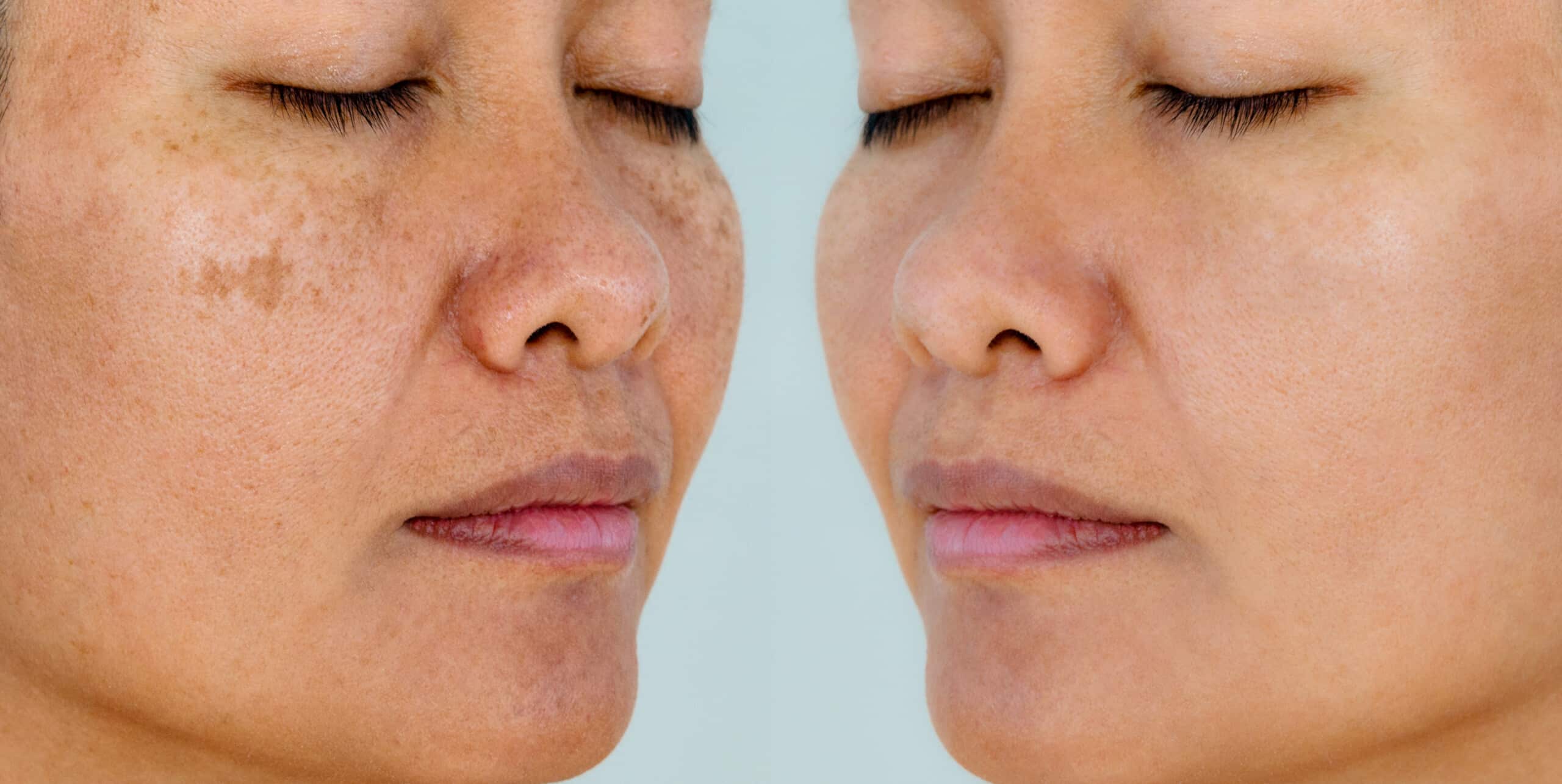 How sun exposure affects skin ageing