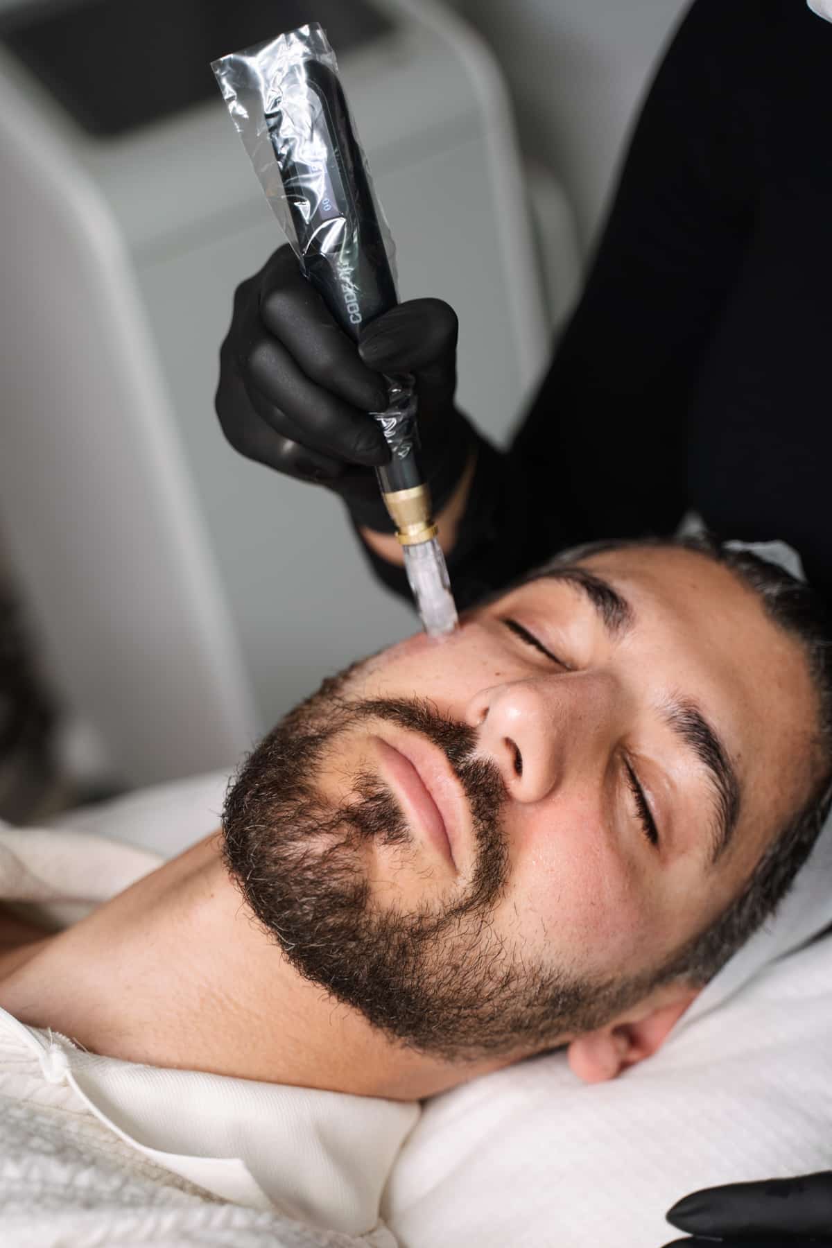 Skin needling sydney