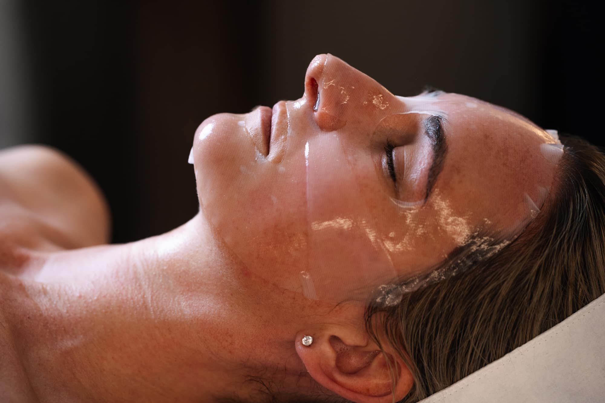 Cosmelan peel sydney