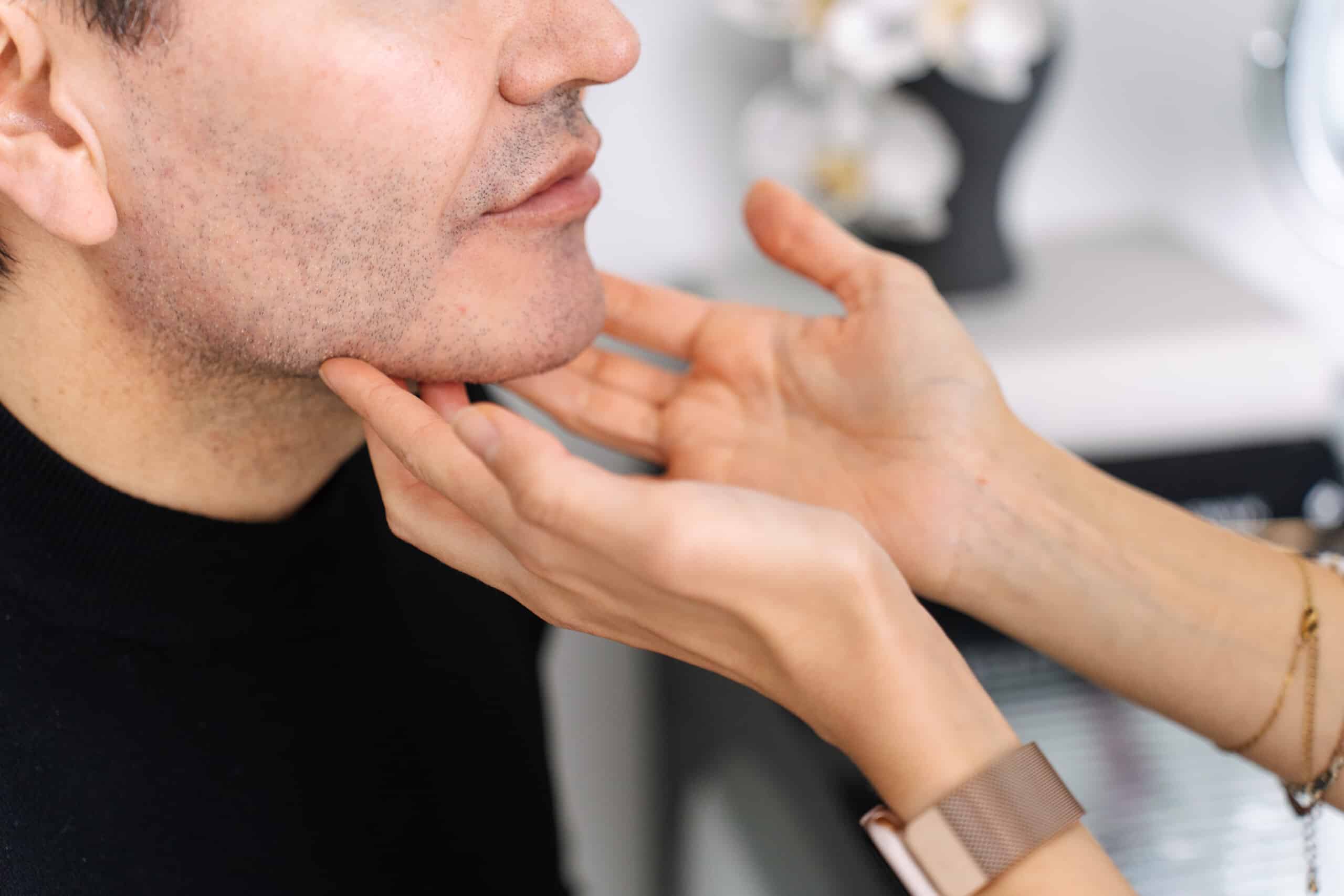 How nasolabial lines (smile lines) may be treated by cosmetic doctors in Sydney and Brisbane at Contour Clinics