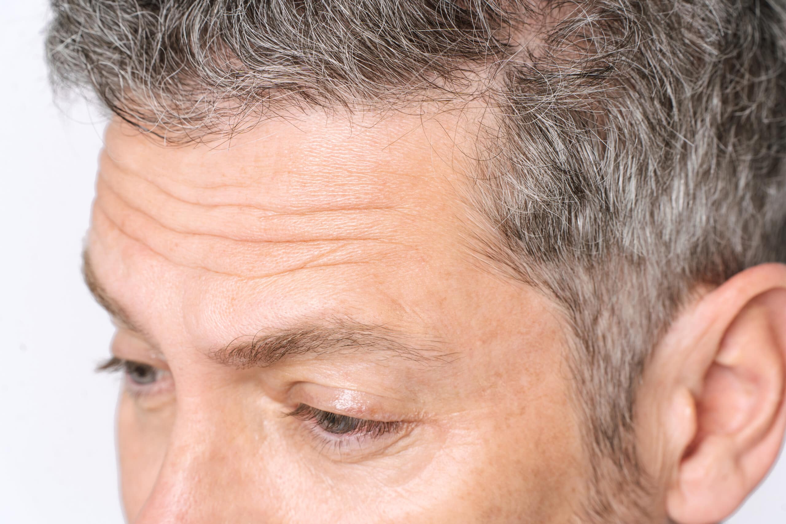 Forehead Wrinkles and Contouring Explained