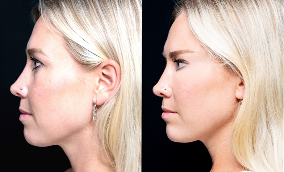 Female Fox Eye Thread before vs after treatment at Contour Clinics