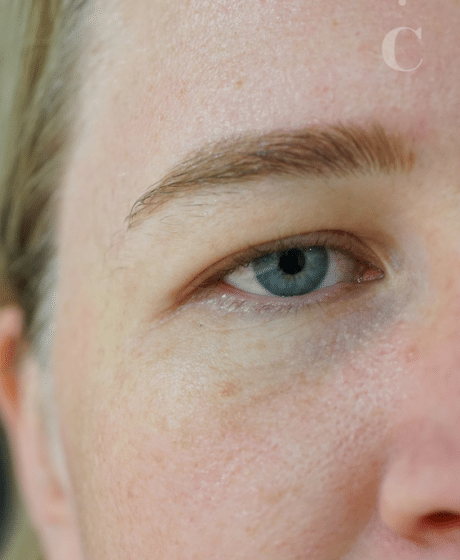 Female Fox Eye Thread before treatment at Contour Clinics