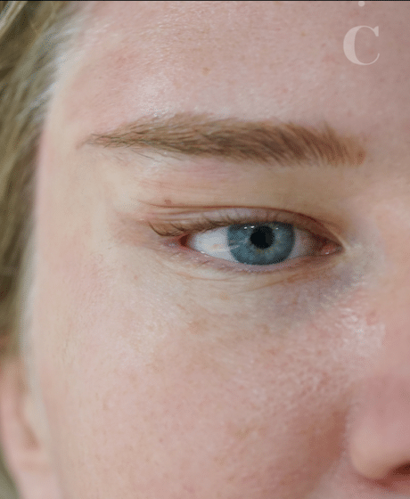 Female Fox Eye Thread after treatment at Contour Clinics