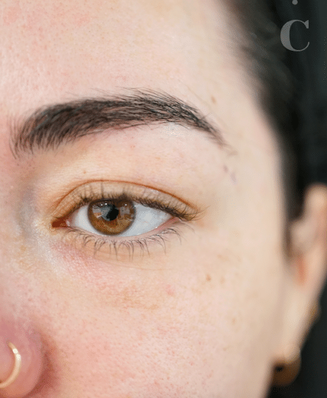 Female Fox Eye Thread before treatment at Contour Clinics