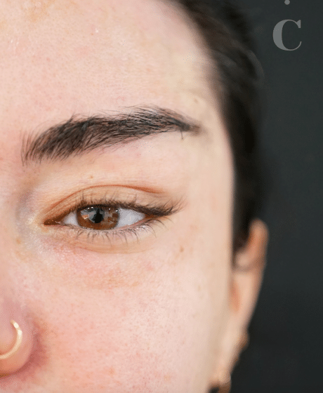 Female Fox Eye Thread after treatment at Contour Clinics