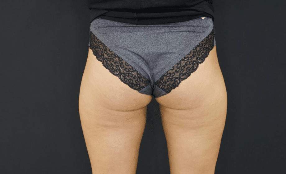 How to get rid of fat without surgery