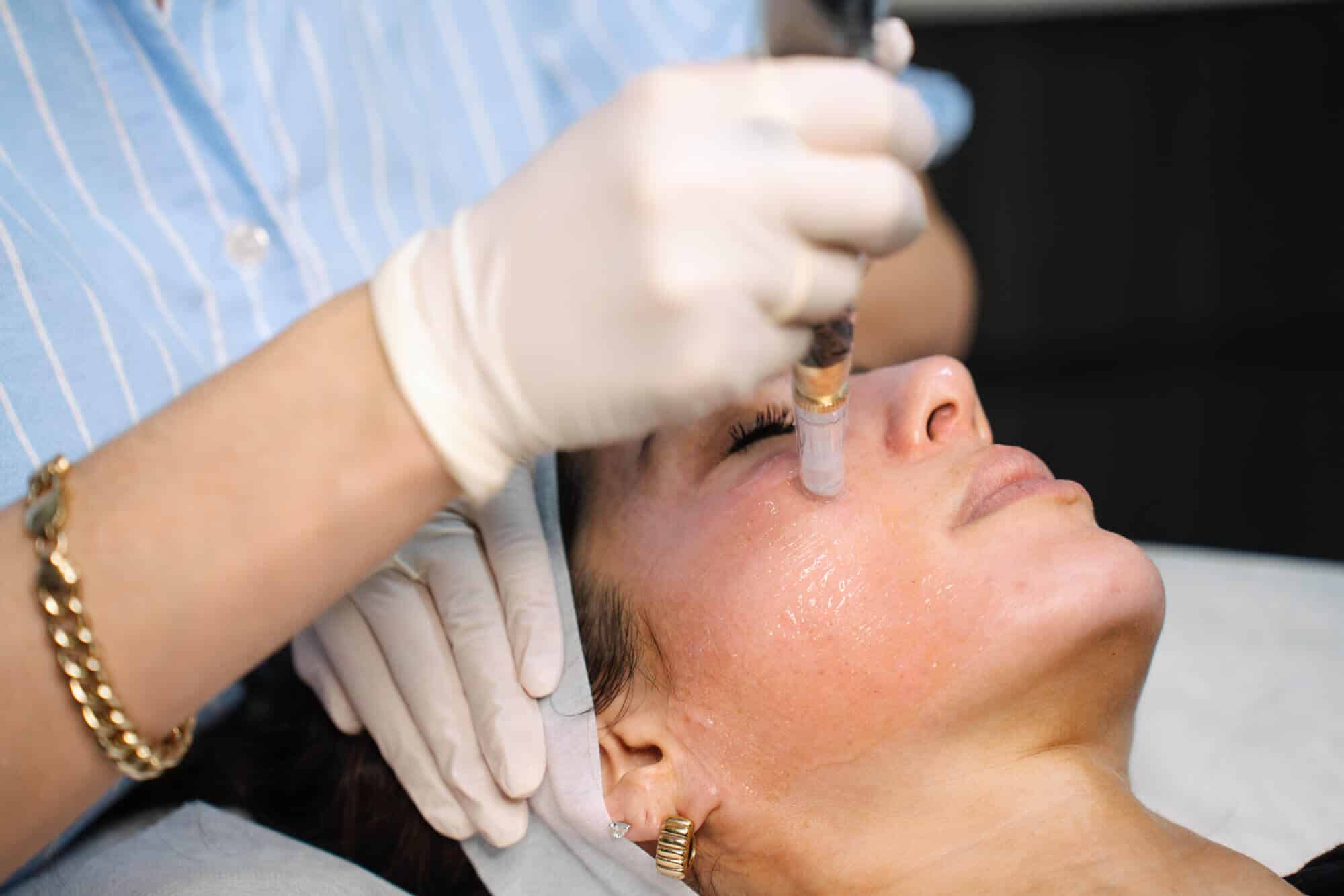 What is skin needling? Explained by cosmetic doctors at Contour Clinics