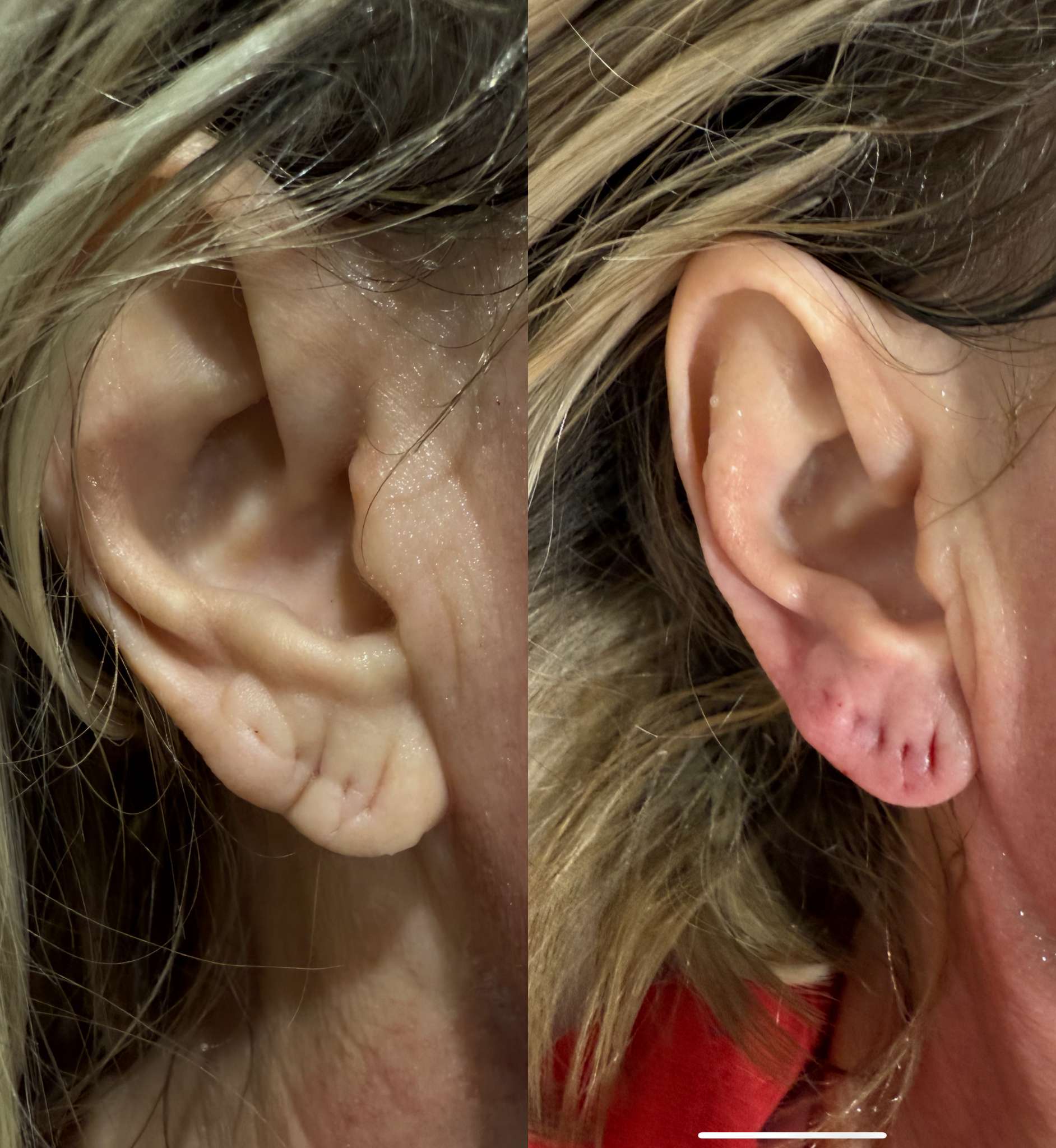 Earlobe filler in sydney and brisbane