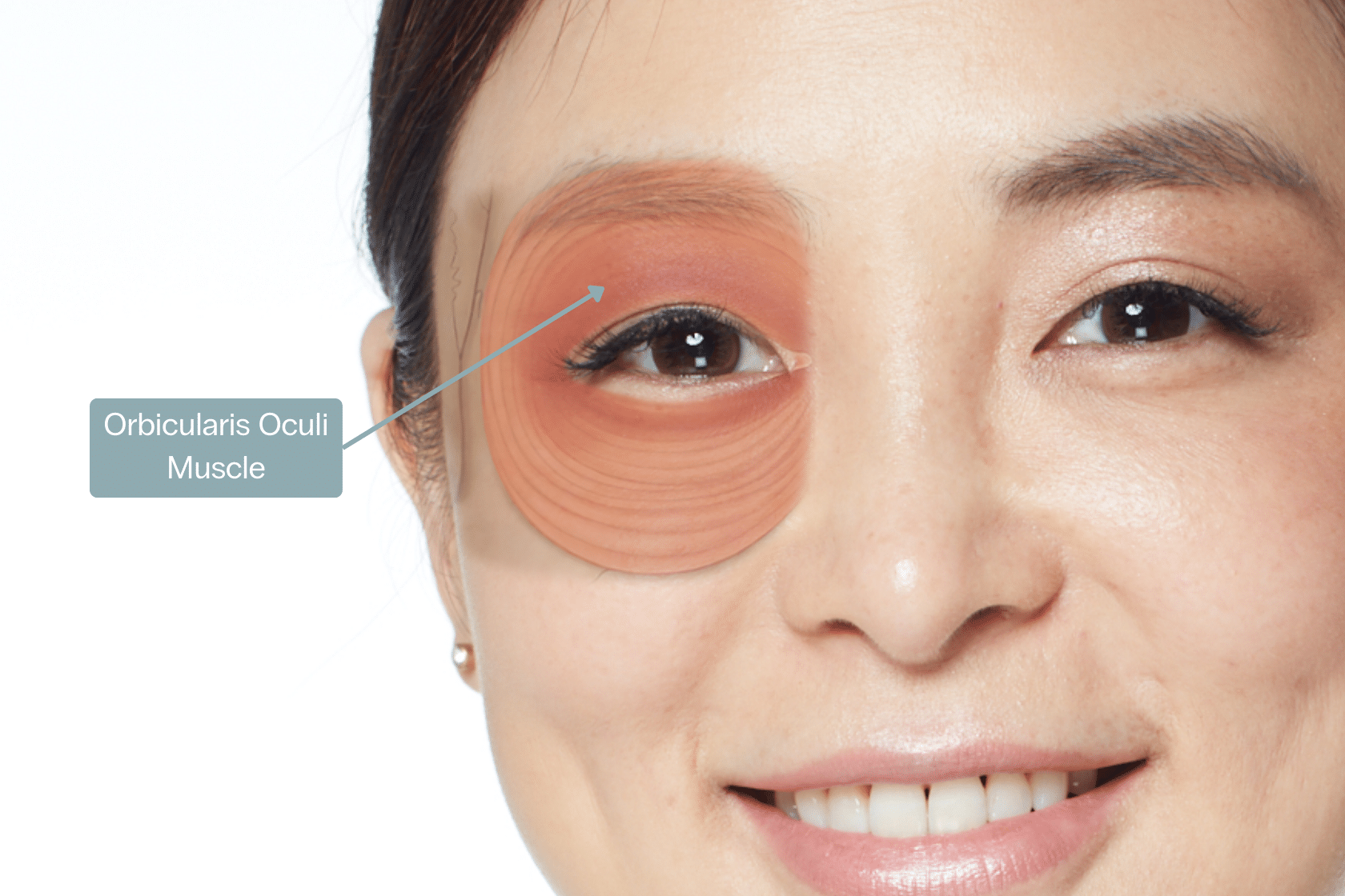 Crows feet treatment sydney