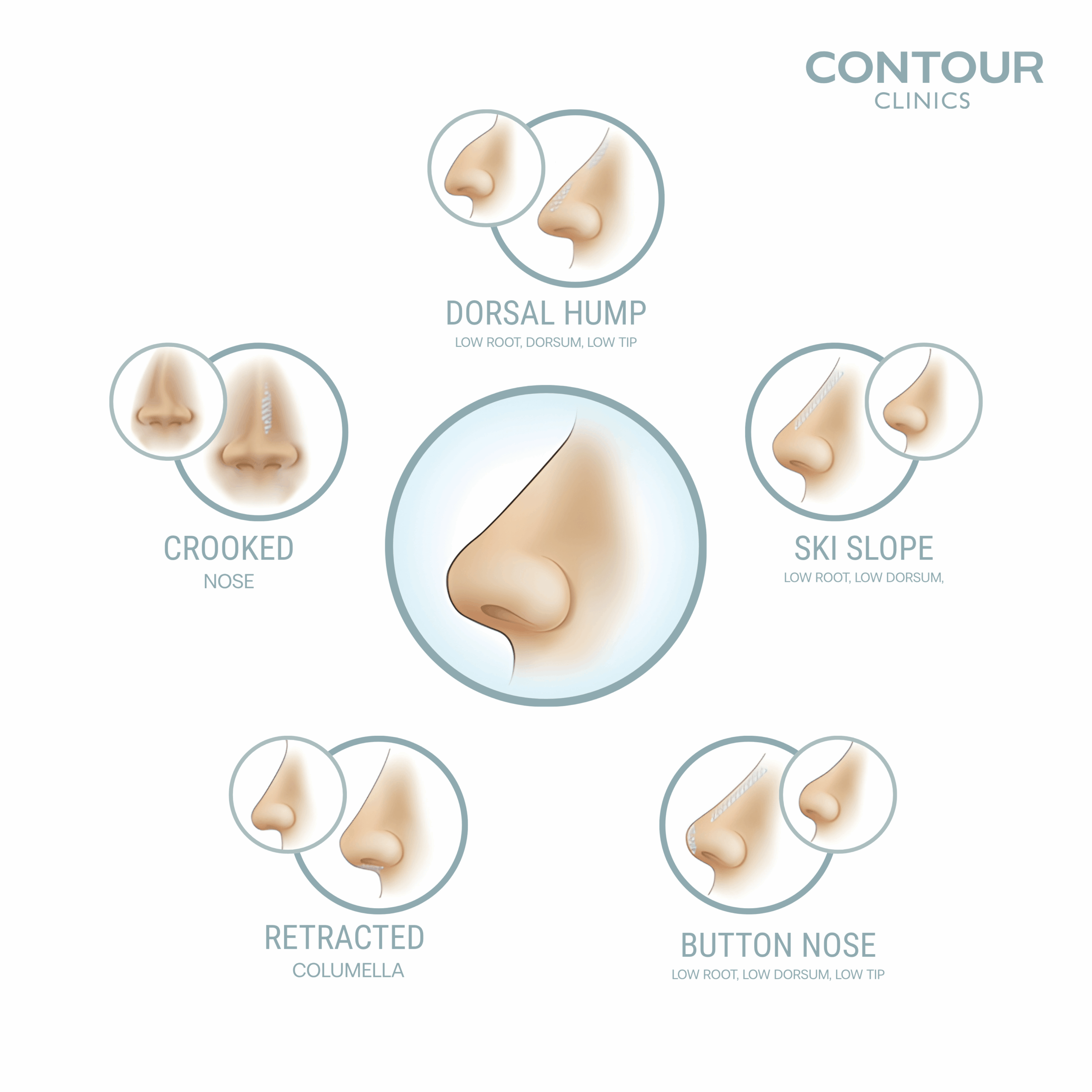 Nose contouring by Contour Clinics