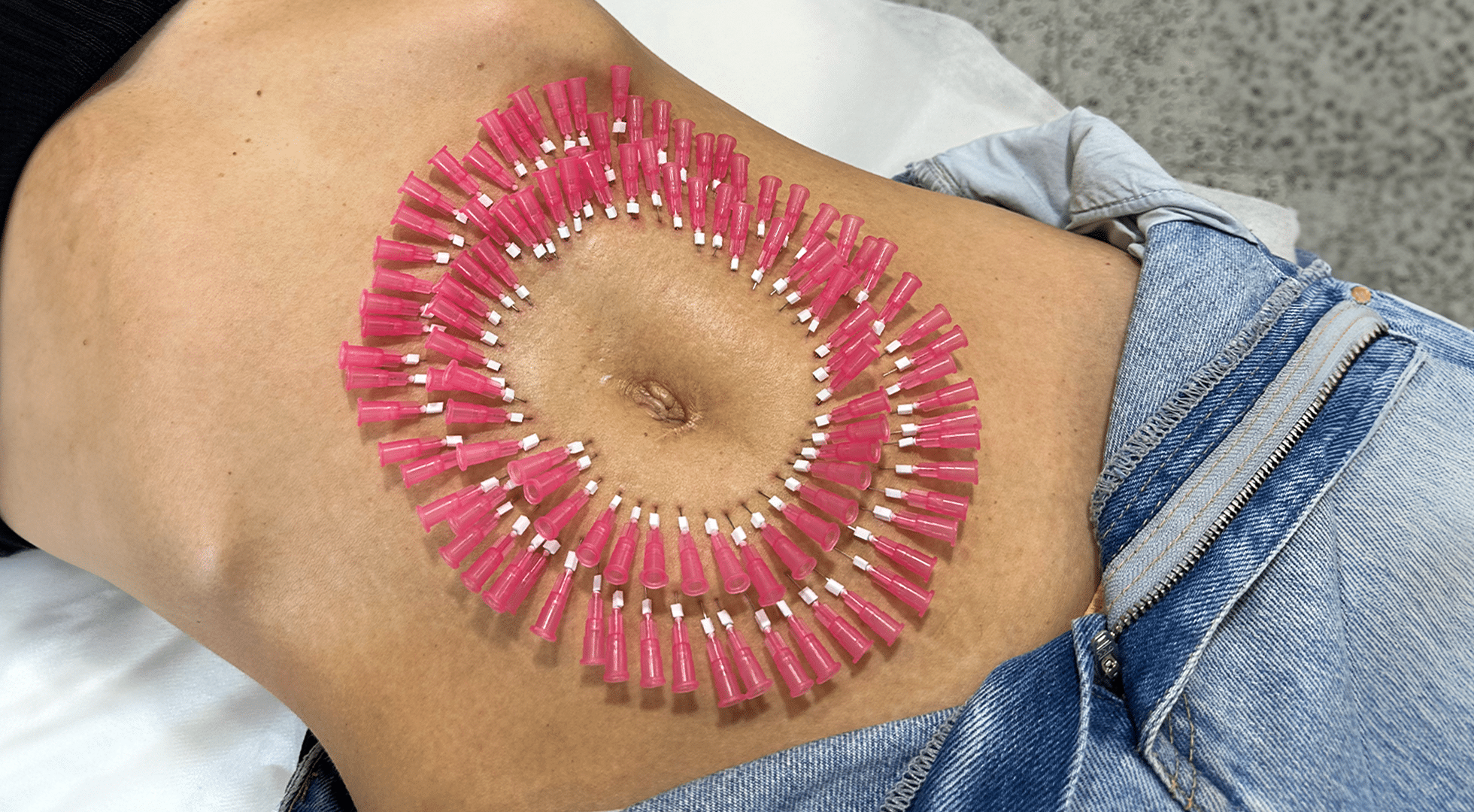 pdo mono threads to the abdomen