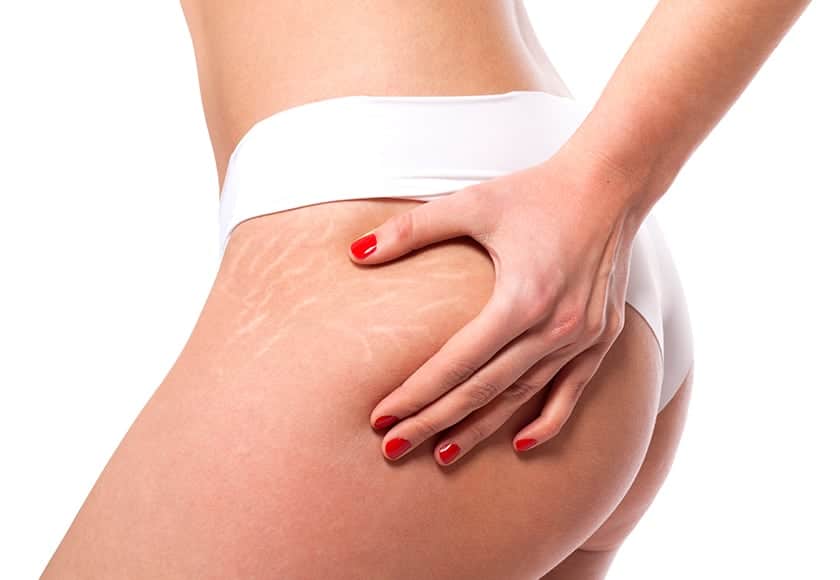 stretchmarks removal sydney