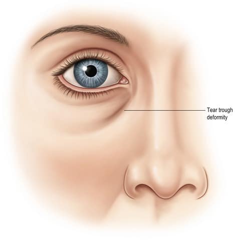 What is a tear trough? Explained by Brisbane and Sydney's leading cosmetic doctors at Contour Clinics